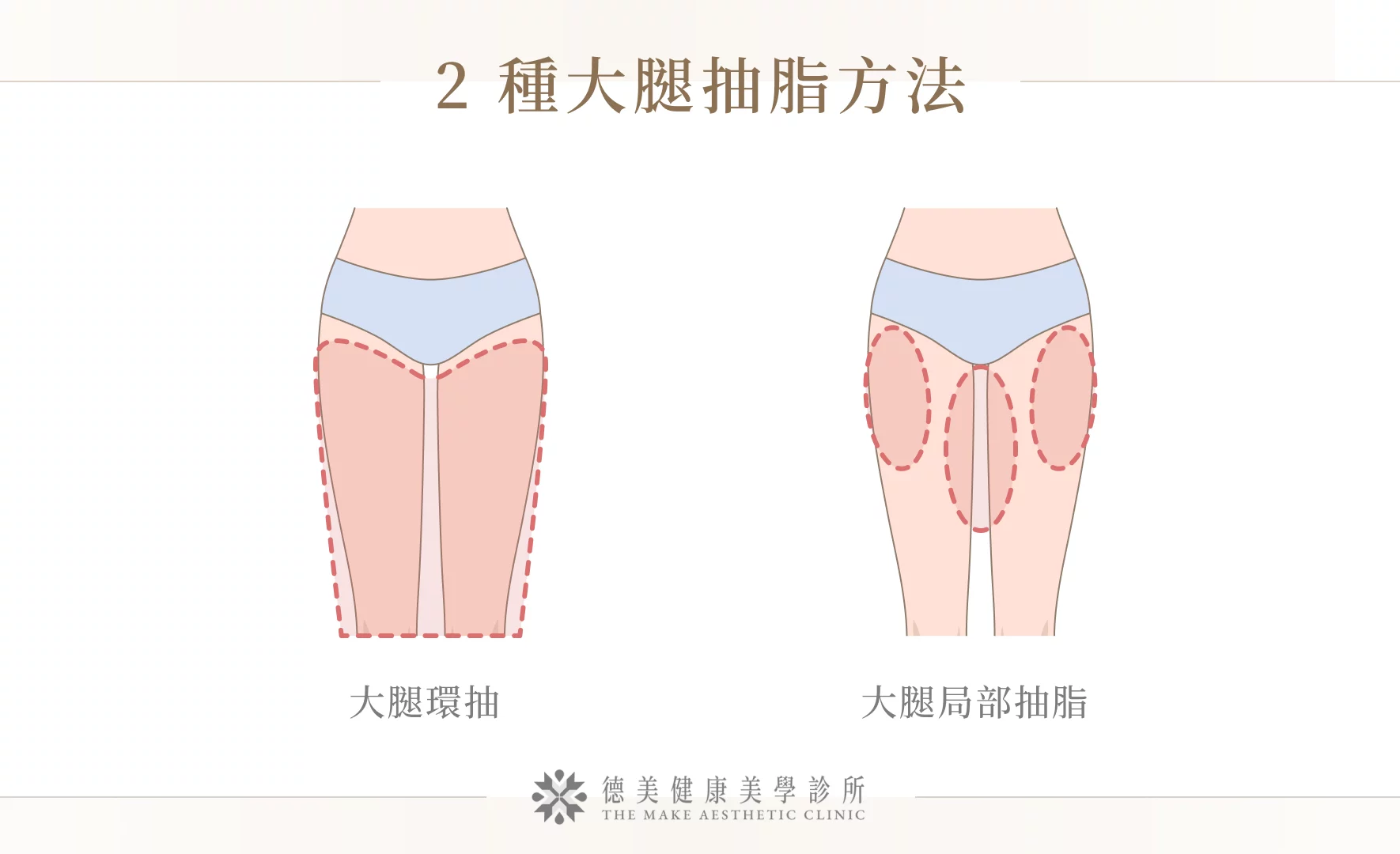 2 種大腿抽脂方法