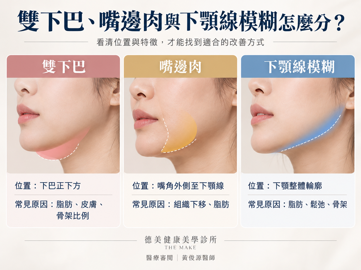 下顎線不明顯的7個常見原因:脂肪、雙下巴、嘴邊肉、皮膚鬆弛、深層組織下移、骨架與混合型