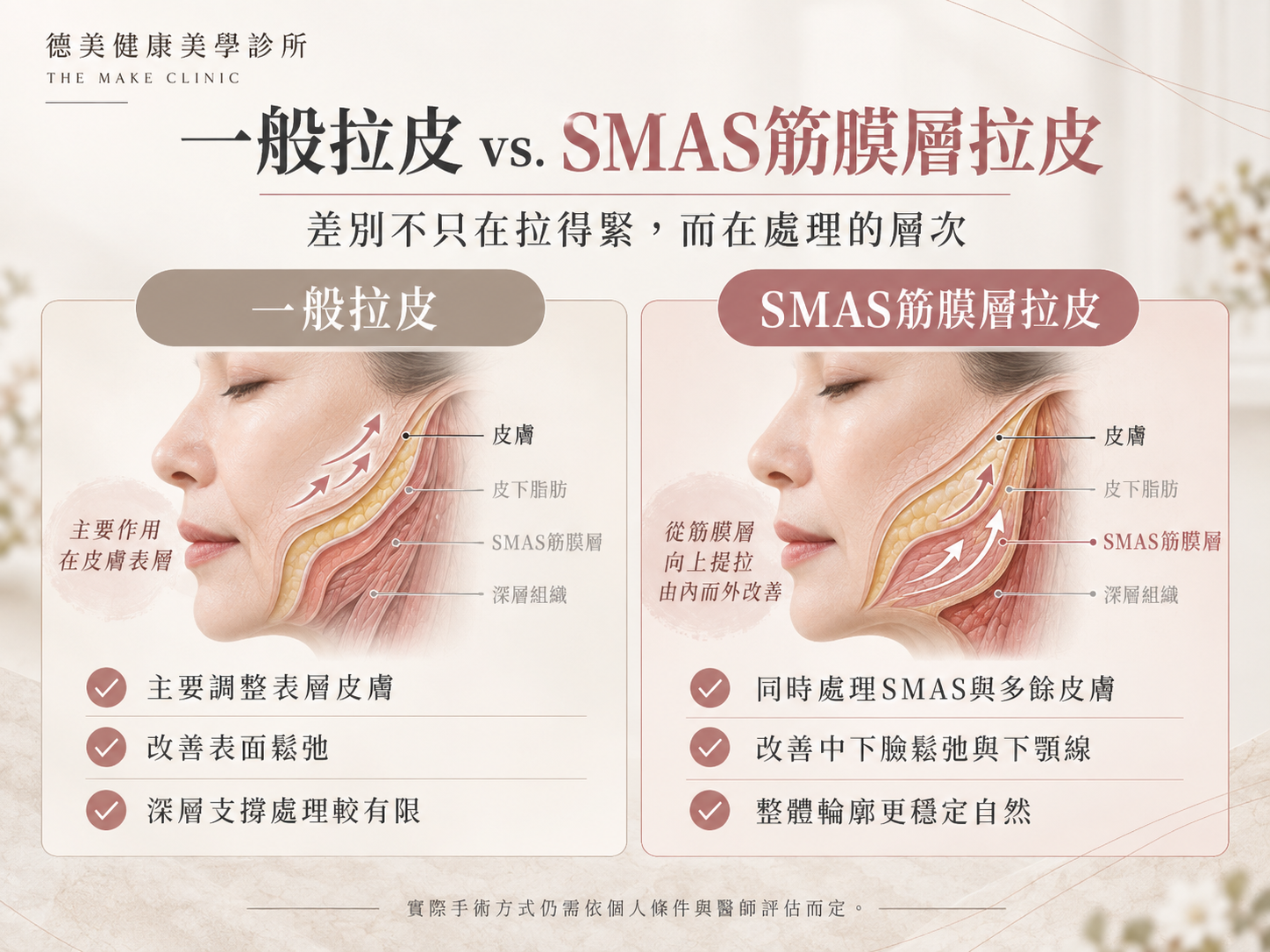 臉部老化分層示意圖,包含皮膚、皮下脂肪、SMAS筋膜層與深層組織